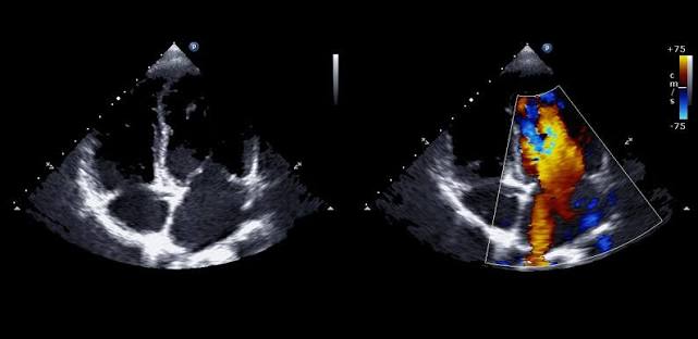 Echocardiogram (Echo)