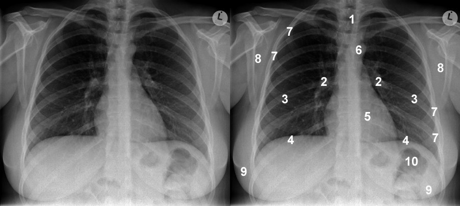 Chest X-Ray (CXR)